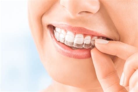 Invisalign Cary Clear Braces Raleigh Nc Straight Teeth Raleigh