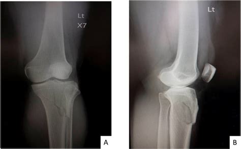 Initial Radiographic Imaging Of Left Knee A Anteroposterior View