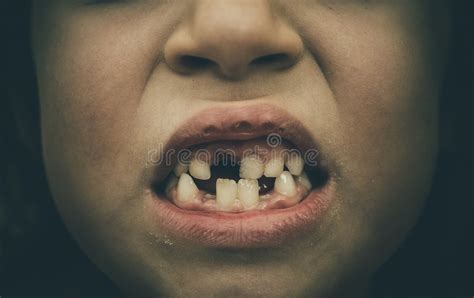 122 Toothless Gums Stock Photos Free And Royalty Free Stock Photos From