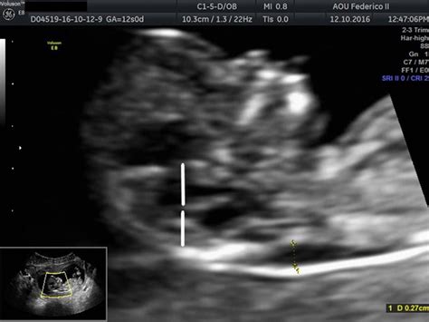 First Trimester Fetal Posterior Brain In A Case Of Spina Bifida With