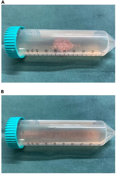 Schema For Neoplastic Pancreas Dissociation A The Minced Tissue In A