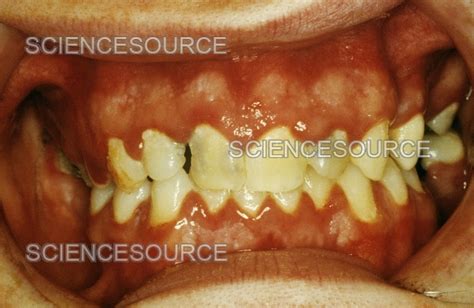 Herpetic Gingivostomatitis