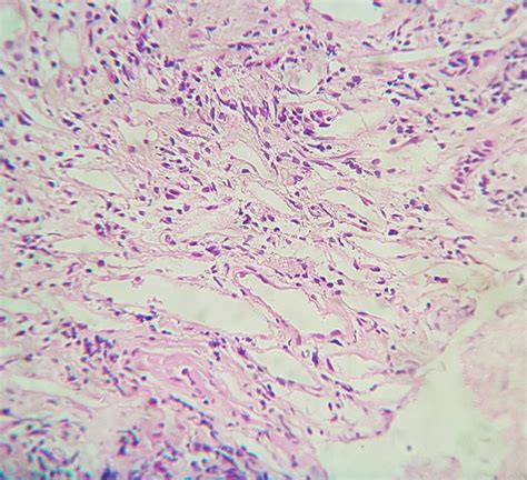 H & E, Primary intestinal lymphangiectasia showing numerous dilated ...