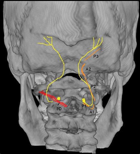 Occipital Nerve Block Injection