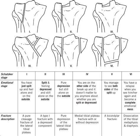 Tibial Plateau Fracture Classification