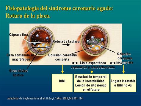 Fisiopatología del síndrome coronario agudo