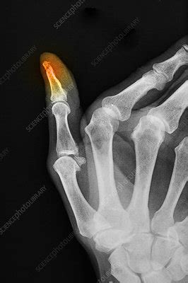 X-ray of Thumb Fracture - Stock Image - C012/3896 - Science Photo Library