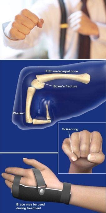 Boxer S Fracture Sarasota FL Schofield Hand And Bright Orthopaedics