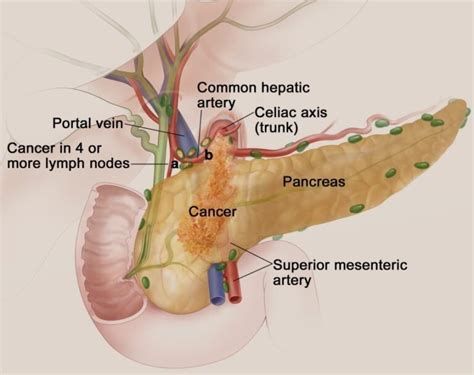 Chemotherapy for Pancreatic Cancer - zeepedia.com