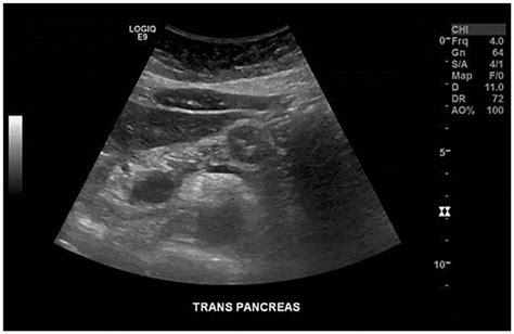 Solid Pseudopapillary Neoplasm Of The Pancreas A Case Report Of A Rare