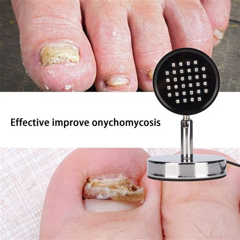 Light Onychomycosis Treatment Device - Effective Onychomycosis Remover