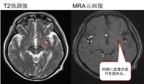 脳MRIで見られる血管周囲腔とは画像のポイントは