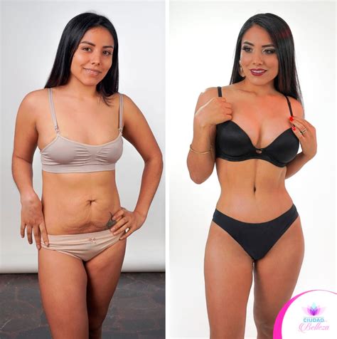 LipoAbdominoplastia Abigail Ciudad Belleza