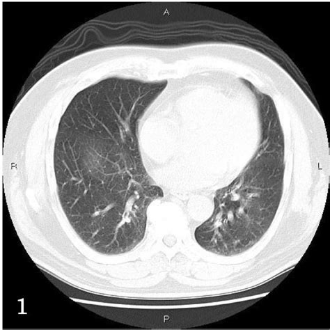 Lung Biopsies A The First Transbronchial Lung Biopsy TBLB It Shows