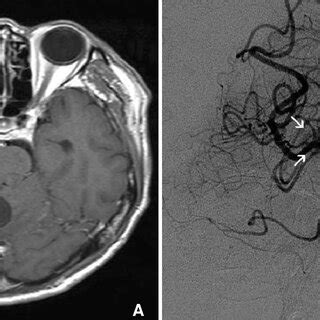 PDF Preoperative Embolization Of Cerebellar Hemangioblastoma With