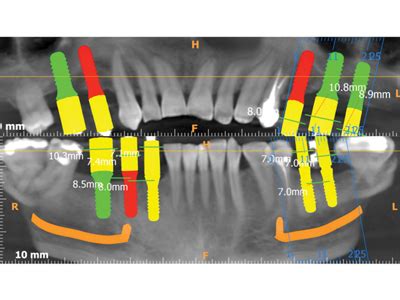 Dubleneau Pre Operative Cbct Image With Maxillary And Mandibular