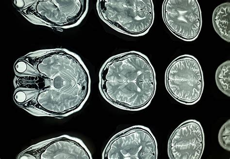 Mri Scan Of The Brain Medical Brain Disease Photo Background And ...