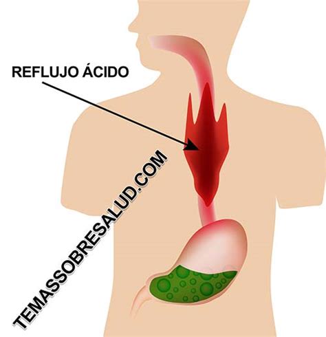 Hernia De Hiato Causas S Ntomas Y Tratamiento