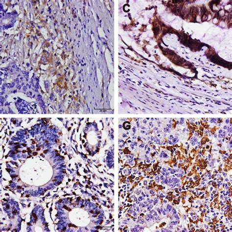 Expression Patterns Of Cmtm6 Pd L1 Cd4 Cd8 Cd68 And Cd163 In Crc