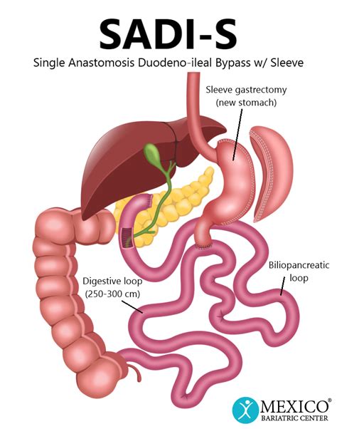 Biliopancreatic Diversion With Duodenal Switch