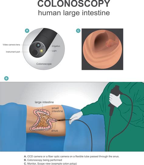 Colonoscopy 101 Benefits Risks And Who Should Get Screened