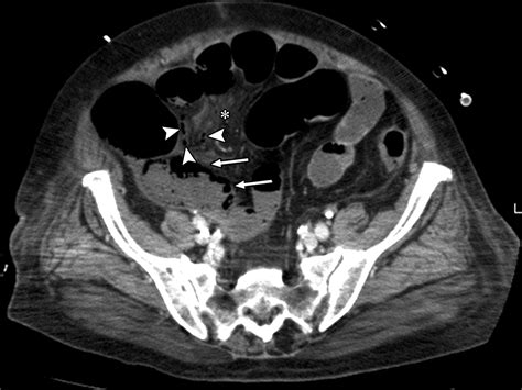 Acute Mesenteric Ischemia Multidetector Ct Findings And Endovascular