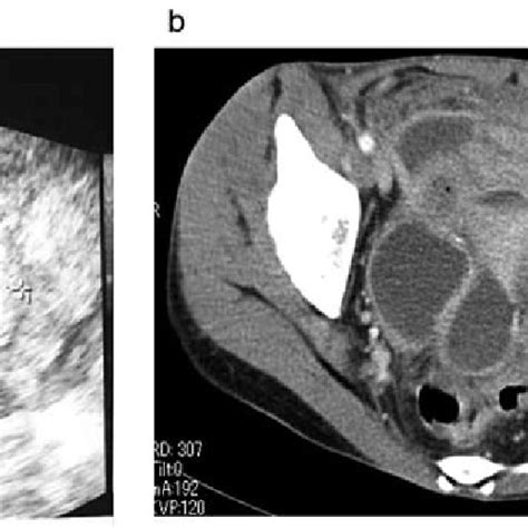 -Histology of the ectopic endometrium in control group. (c) Arrows show ... 