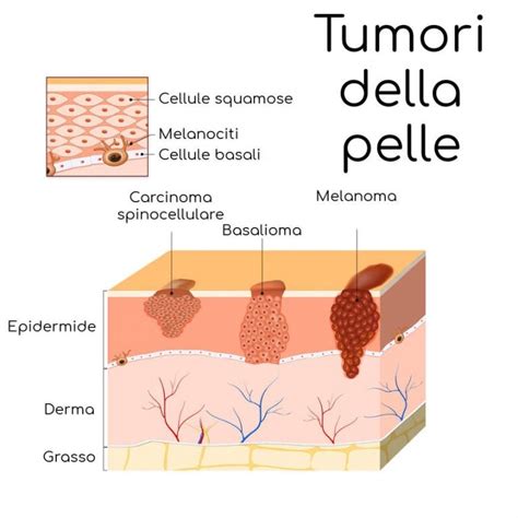 Basalioma Della Pelle Foto Sintomi E Cura