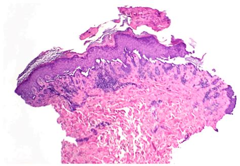 Skin Punch Biopsy Specimen Displaying Superficial Crusting With Basilar