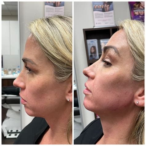 Patient Jawline Augmentation Gallery Before After Photos