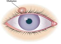 eye-chalazion-treatment - Chatswood Eye Specialists