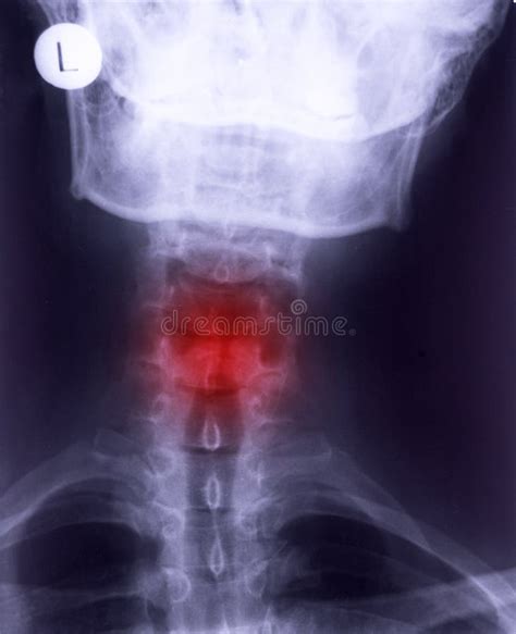 X-ray of neck stock image. Image of defect, human, radiography - 118005579