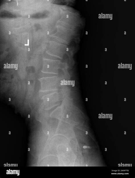 Pellicola Radiografica O Radiografia Delle Vertebre Lombari Della