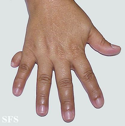 Polydactyly - wikidoc