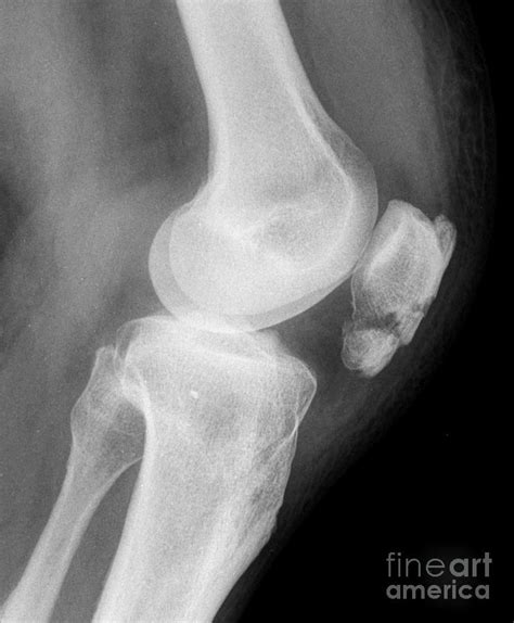 Broken Knee Cap Photograph By Rajaaisyascience Photo Library Fine