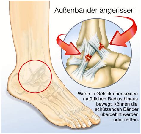 Bänderverletzung Spezialisten Infos