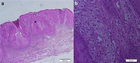 Xanthoma Histology