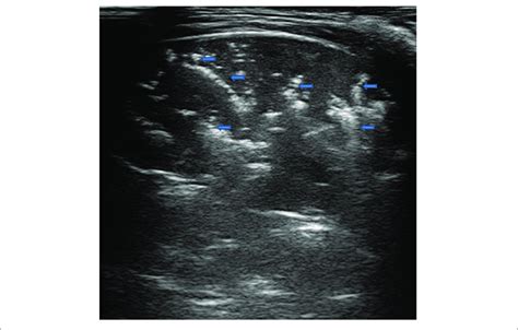 Grayscale Lung Ultrasound Examination Transverse Scan Between