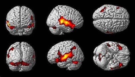 Enfermedades Del Cerebro Inf Rmate Sobre Stas