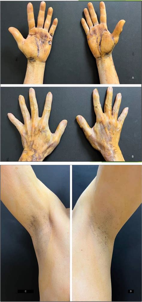 Anhidrosis In Humans