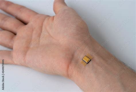 Microchip Is Connected To A Man Hand Implantation Of A Chip Under The