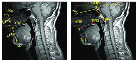 Craniofacial Heights And Angles A Subspinale Ans Anterior Nasal