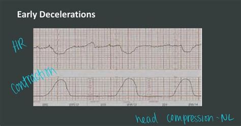 Intrapartum Fetal Surveillance Flashcards Quizlet