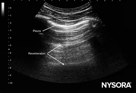 Ultrasound Image Artifacts Explained Nysora Nysora