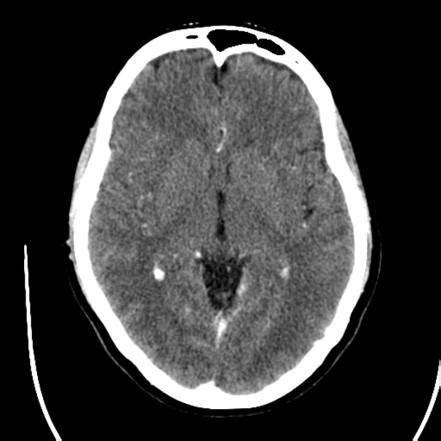 Normal Ct Scan Of Brain