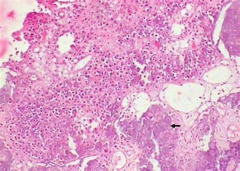 Photomicrograph Of Histopathology Sections Showing Tumor Cells With