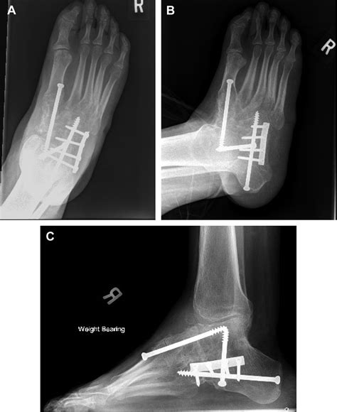 Triple Arthrodesis Foot And Ankle Clinics