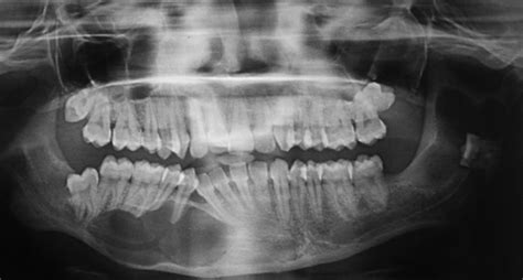 In Orthopantomogram Was Taken Which Showed Two Well Defined