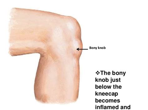 Osgood Schlatter Disease