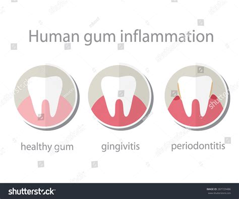 Human Gum Inflammation Stock Illustration 287729486 Shutterstock